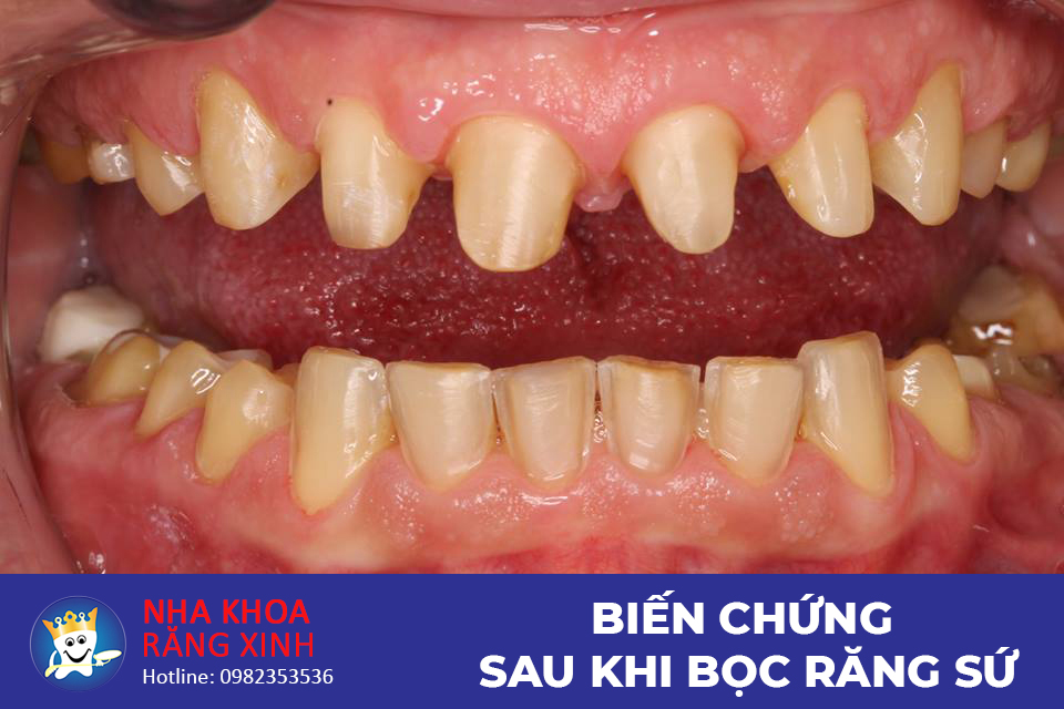 Nếu không đúng quy trình khi bọc răng sứ có thể gây ra nhiều biến chứng nguy hiểm, ảnh hưởng xấu đến sức khỏe.