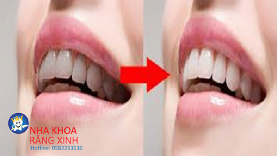 Bọc răng sứ đang là xu thế thẩm mỹ phổ biến hiện. mang lại vẻ đẹp cho bộ răng của bạn.