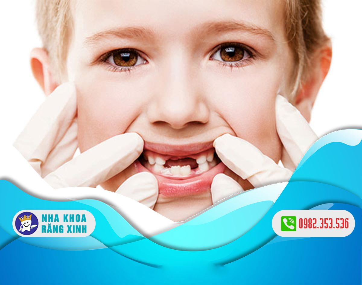 Sâu răng sữa ở trẻ nhỏ và các cách phòng tránh đơn giản, triệt để